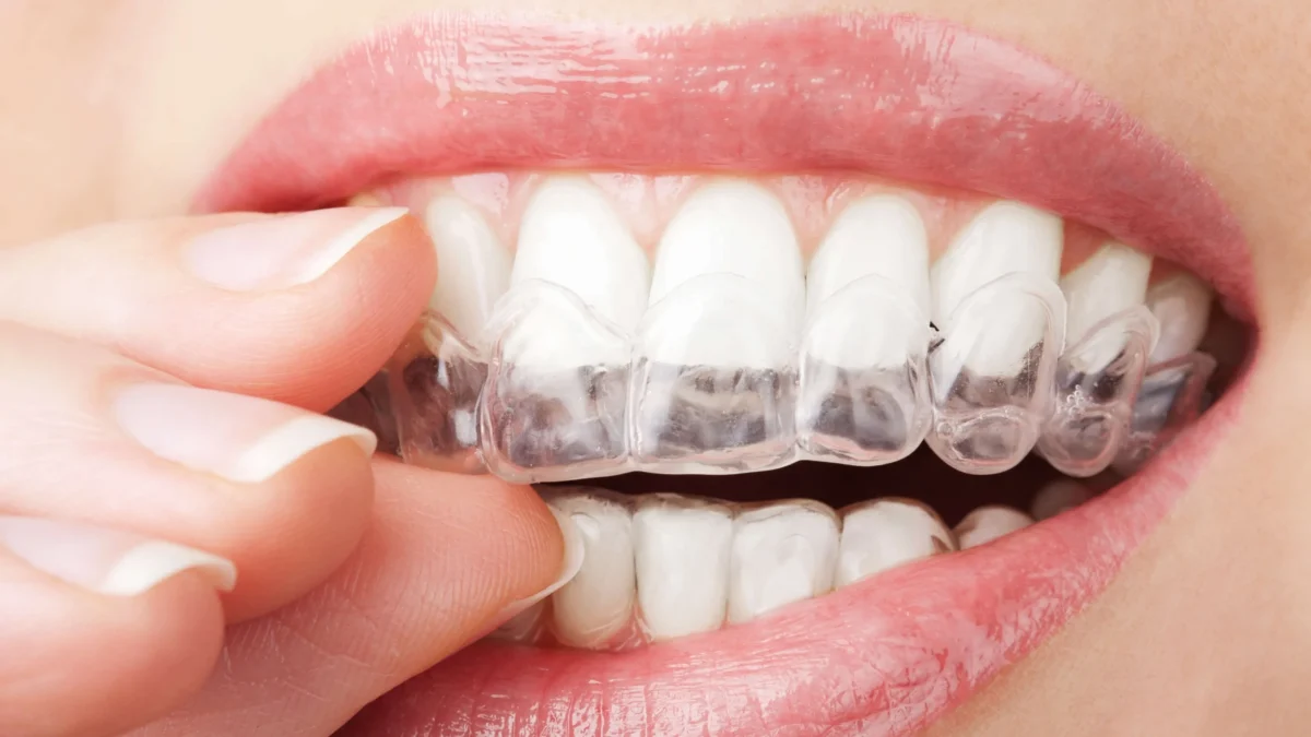 Invisalign